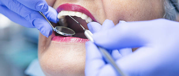 Best Knocked-Out Tooth (Avulsed Tooth) Treatment in Cudahy, WI
